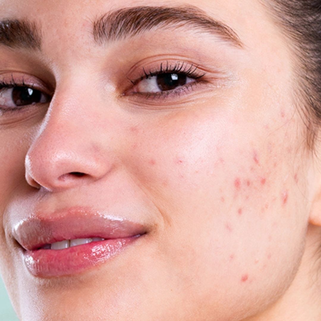Close-up of a woman's face with visible acne and blemishes, highlighting skin texture and natural complexion.