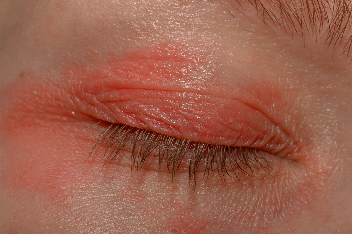 Eczéma atopique du visage et du cou soin et gestes doux au quotidien — free download