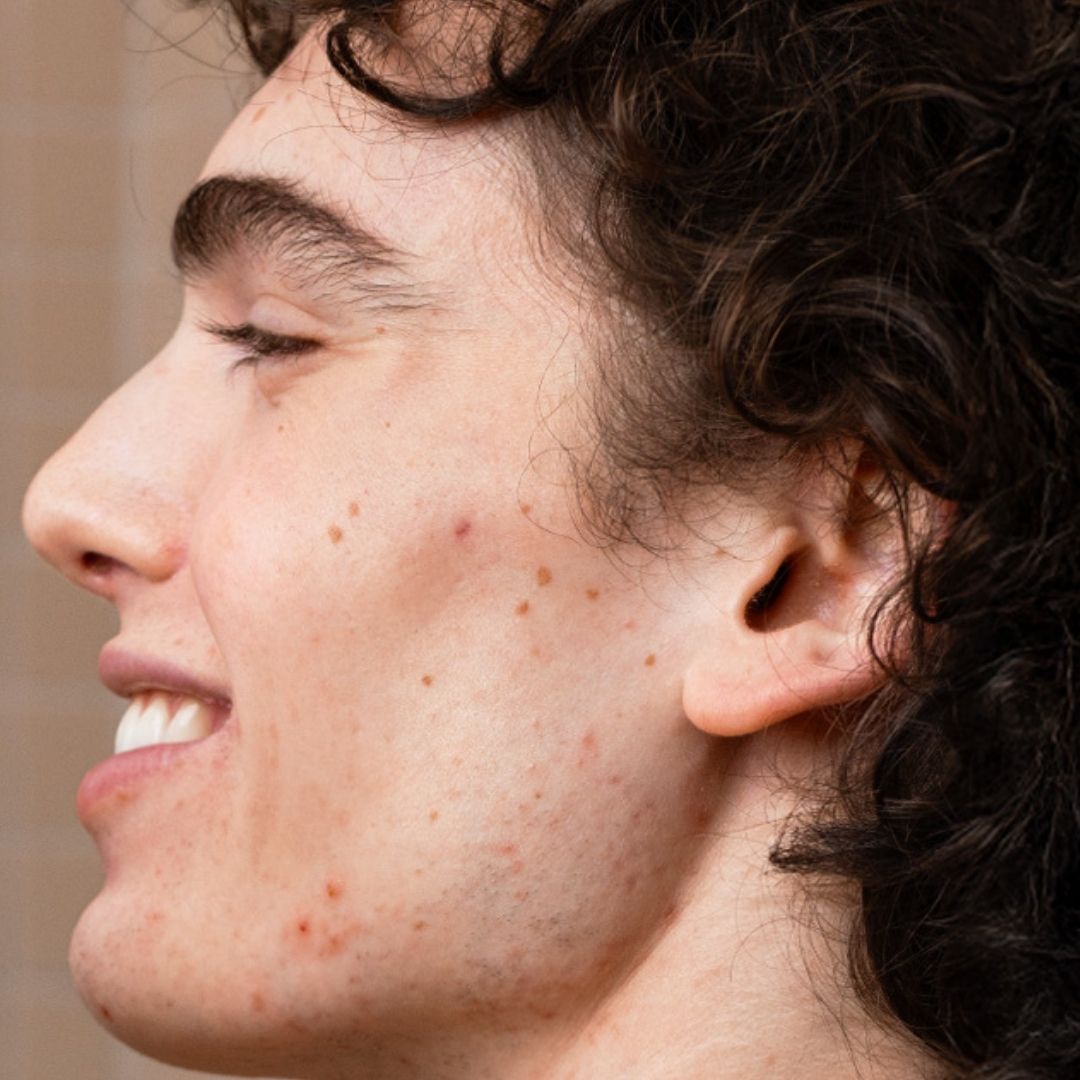 Side profile of a smiling young person with curly dark hair and visible skin texture and acne spots.