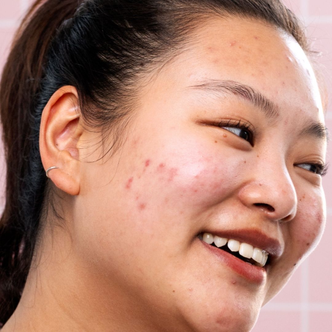 Smiling young woman with acne-prone skin and a silver hoop earring, shown in a close-up profile view.
